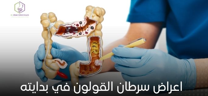 اعراض سرطان القولون في بدايته