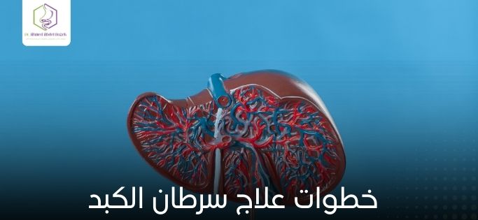 خطوات علاج سرطان الكبد