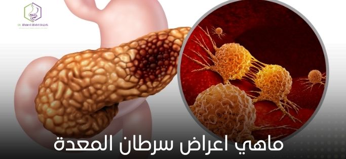 ماهي اعراض سرطان المعدة