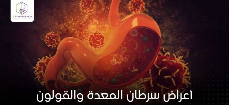 أعراض سرطان المعدة والقولون