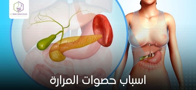 اسباب حصوات المرارة