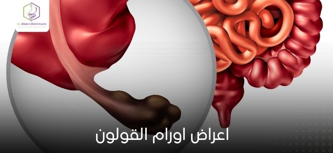 اعراض اورام القولون