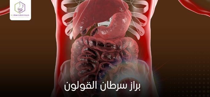 براز سرطان القولون