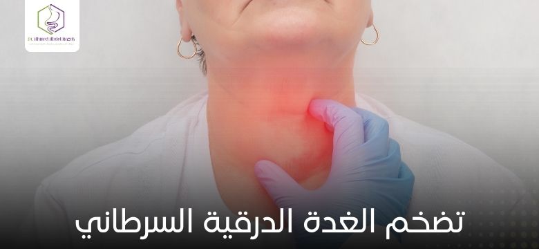 تضخم الغدة الدرقية السرطاني