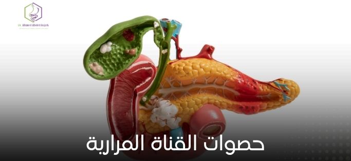 حصوات القناة المرارية