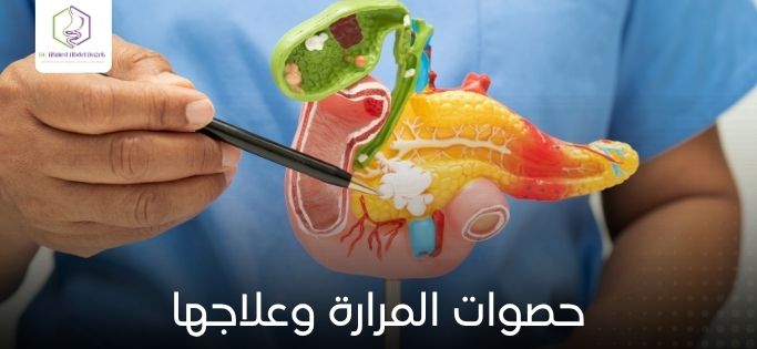 حصوات المرارة وعلاجها