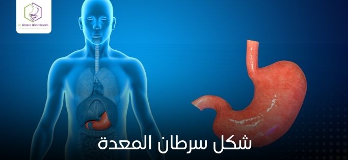 شكل سرطان المعدة