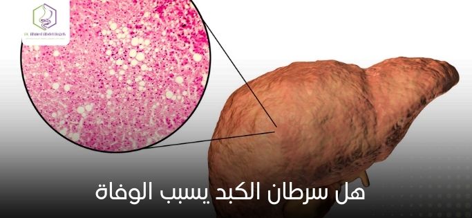 هل سرطان الكبد يسبب الوفاة