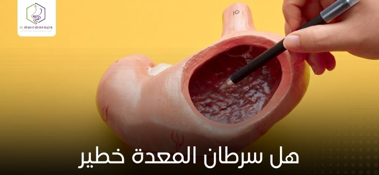 هل سرطان المعدة خطير