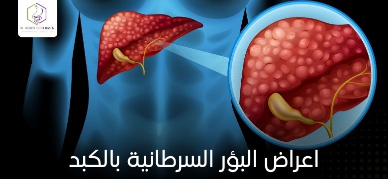 اعراض البؤر السرطانية بالكبد