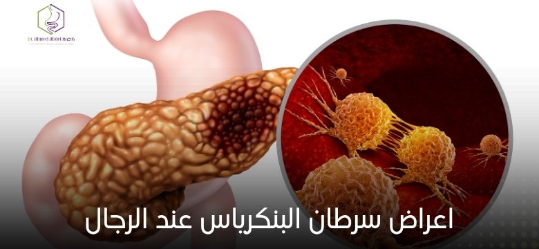 اعراض سرطان البنكرياس عند الرجال
