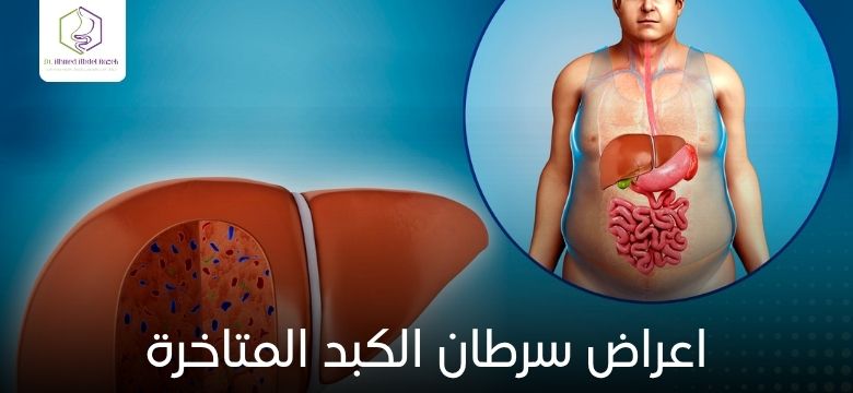اعراض سرطان الكبد المتاخرة