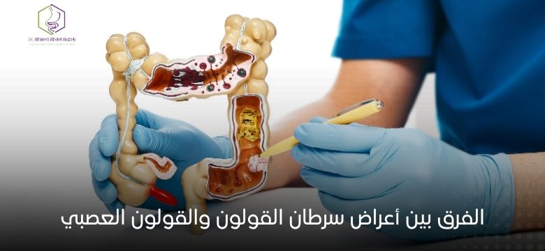 الفرق بين أعراض سرطان القولون والقولون العصبي
