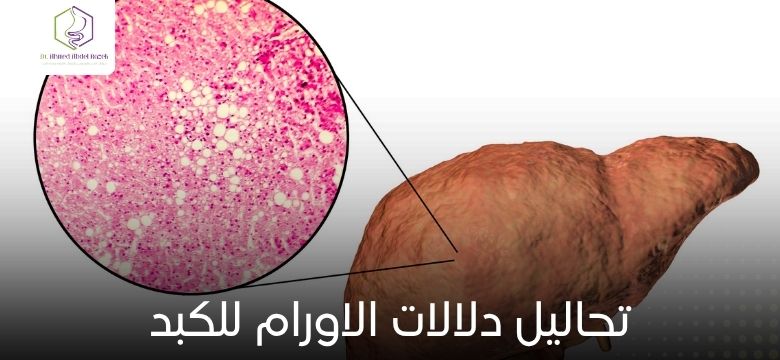 تحاليل دلالات الاورام للكبد