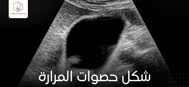 شكل حصوات المرارة