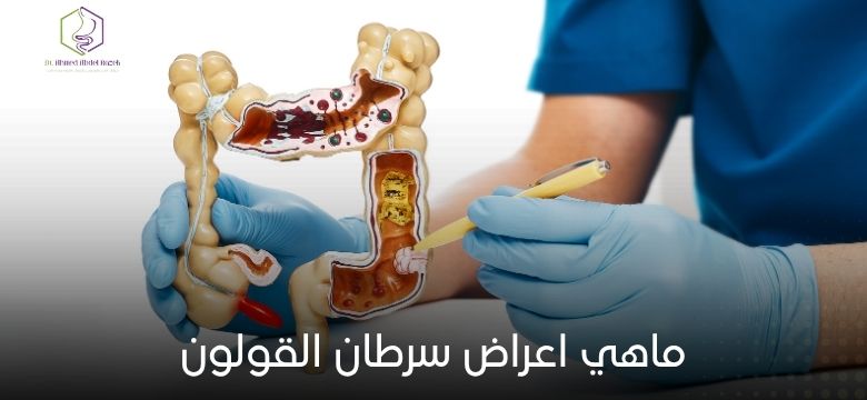 ماهي اعراض سرطان القولون