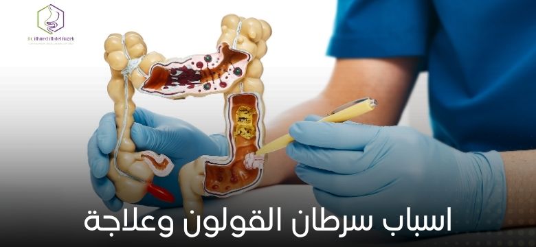 اسباب سرطان القولون وعلاجة