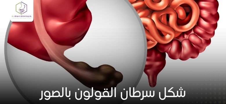 شكل سرطان القولون بالصور