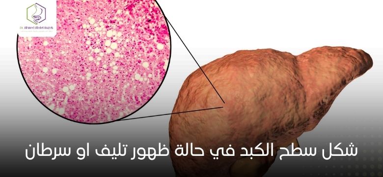 شكل سطح الكبد في حالة ظهور تليف او سرطان