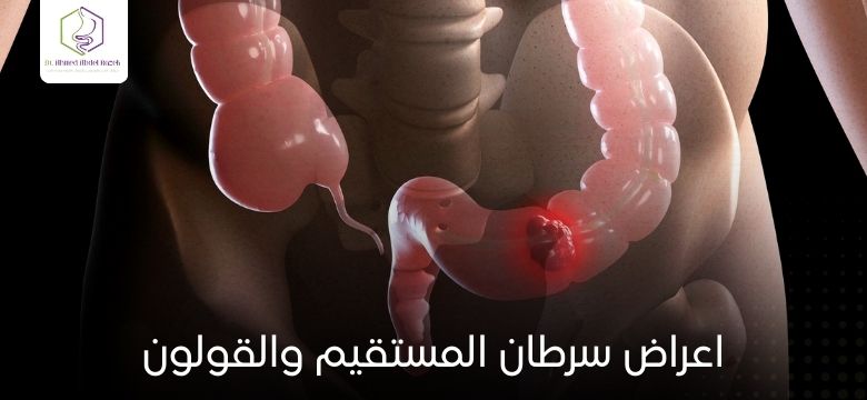 اعراض سرطان المستقيم والقولون