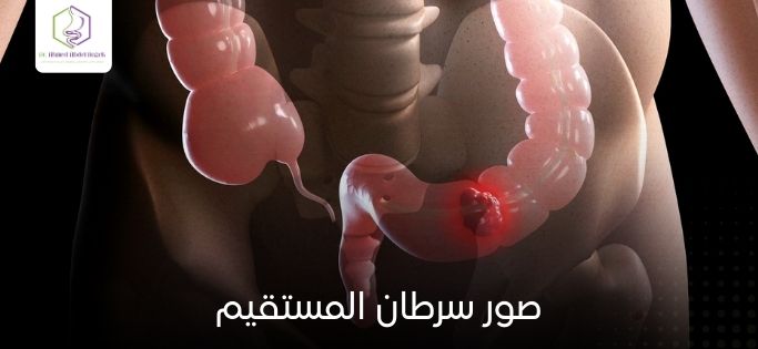 صور سرطان المستقيم