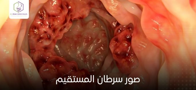 صور سرطان المستقيم