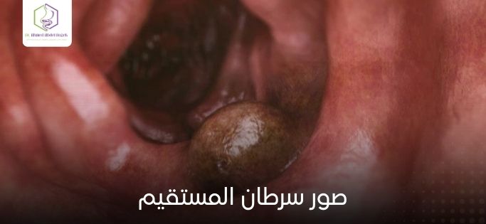 صور سرطان المستقيم