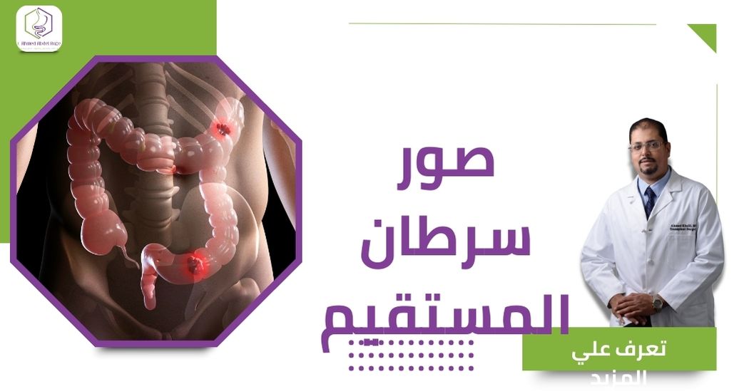 صور سرطان المستقيم