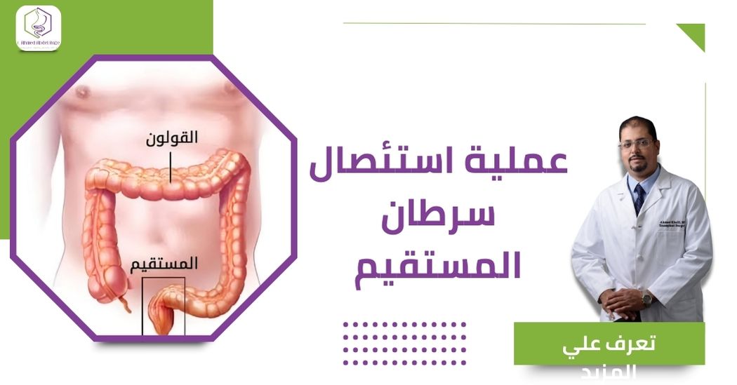 عملية استئصال سرطان المستقيم