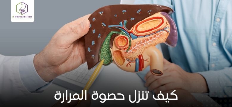 كيف تنزل حصوة المرارة