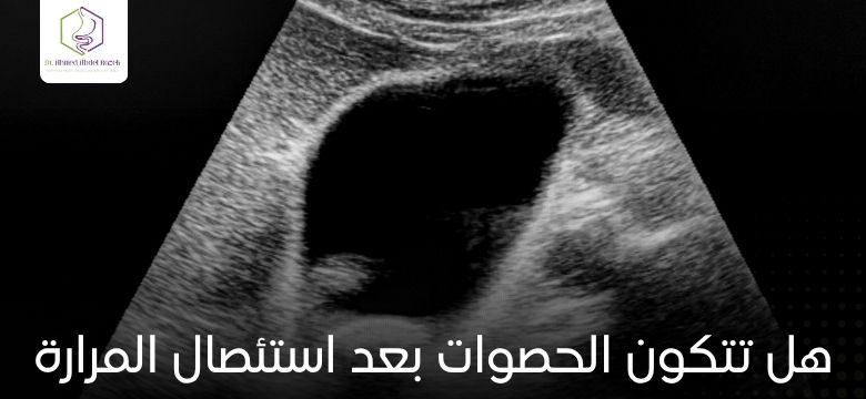 هل تتكون الحصوات بعد استئصال المرارة