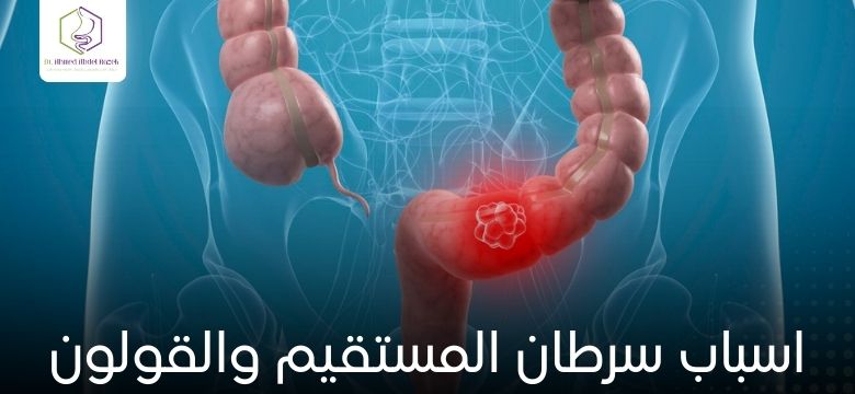 اسباب سرطان المستقيم والقولون