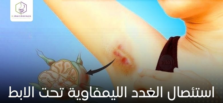 استئصال الغدد الليمفاوية تحت الابط