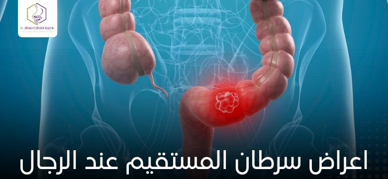 اعراض سرطان المستقيم عند الرجال