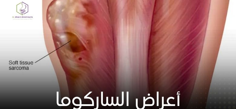 أعراض الساركوما