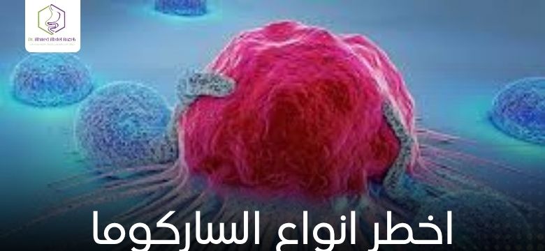 اخطر انواع الساركوما