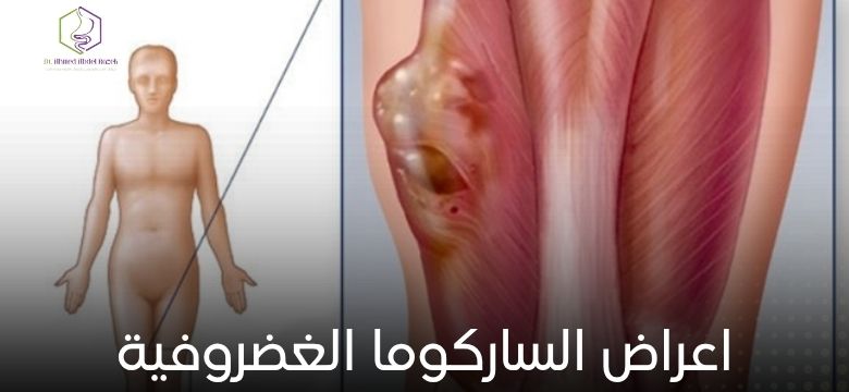 اعراض الساركوما الغضروفية