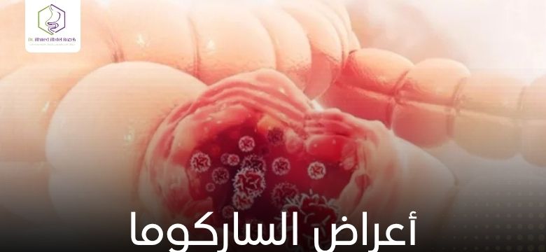 الساركوما الليفية