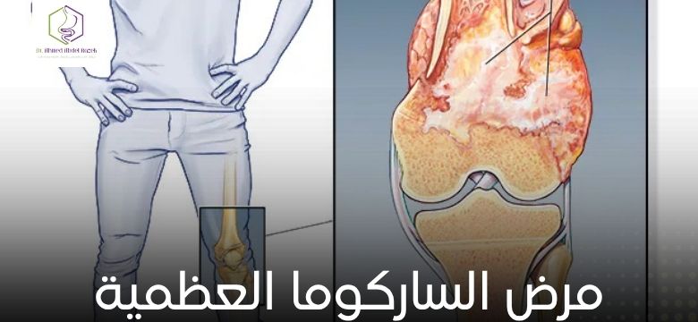 مرض الساركوما العظمية