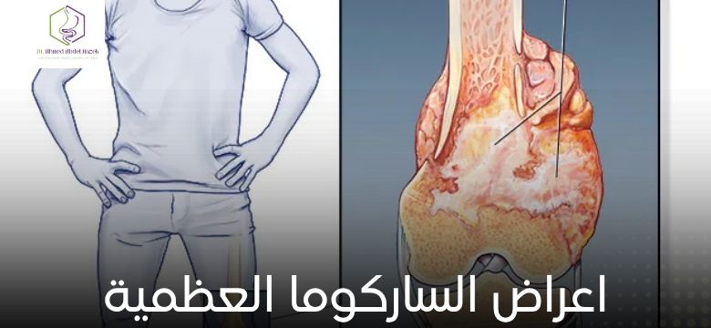 اعراض الساركوما العظمية