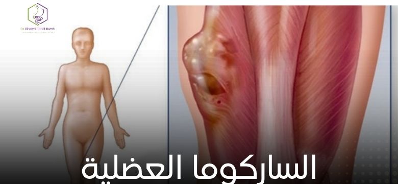 الساركوما العضلية