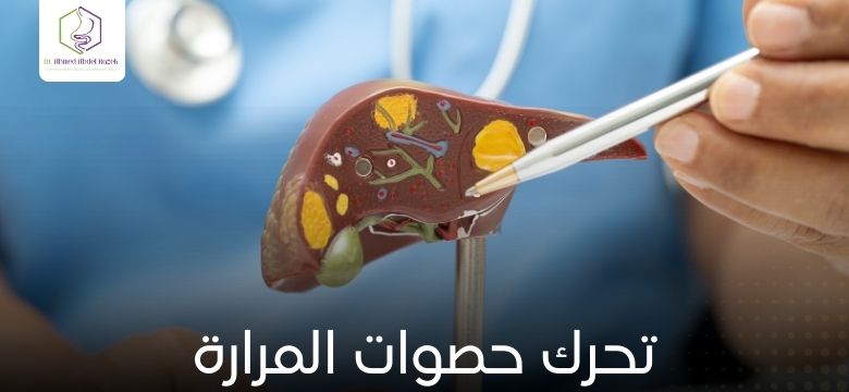 تحرك حصوات المرارة