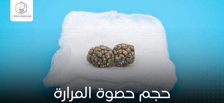 حجم حصوة المرارة
