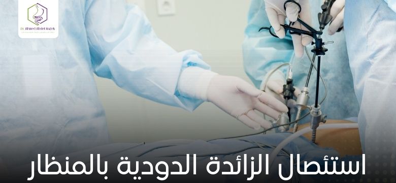 استئصال الزائدة الدودية بالمنظار