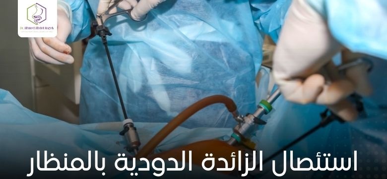 استئصال الزائدة الدودية بالمنظار