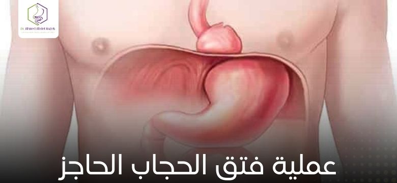 عملية فتق الحجاب الحاجز