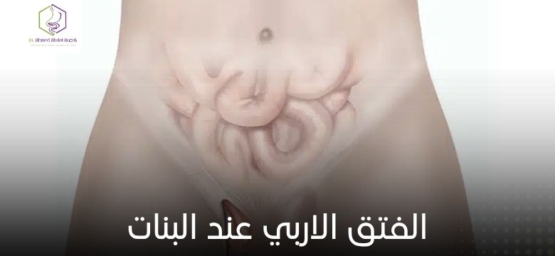 الفتق الاربي عند البنات