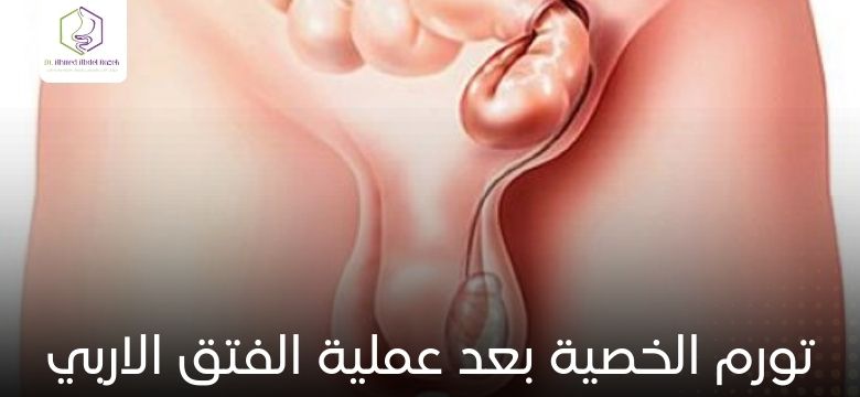 تورم الخصية بعد عملية الفتق الاربي