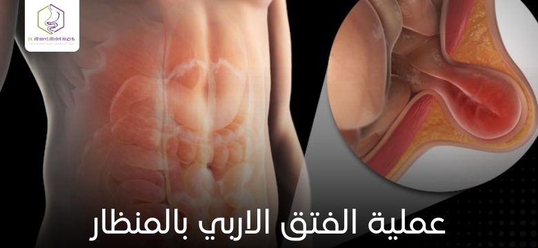 عملية الفتق الاربي بالمنظار