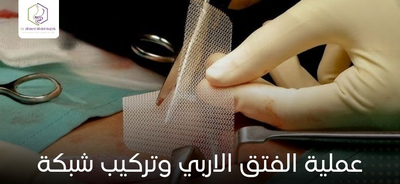 عملية الفتق الاربي وتركيب شبكة